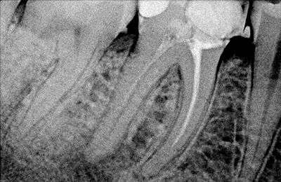 Root Canal Retreatment