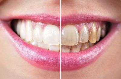 Lipner Endo Teeth Whitening