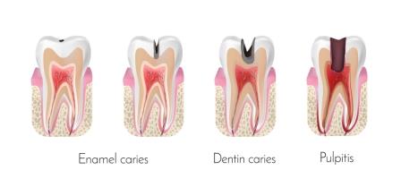 Root canal development stages from decay to pulpitis