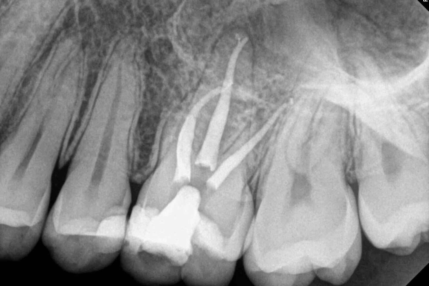 After molar root canal