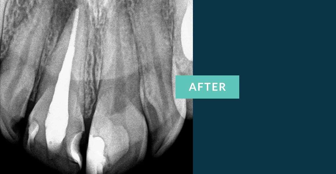 Before Anterior Tooth Root Canal Treatment