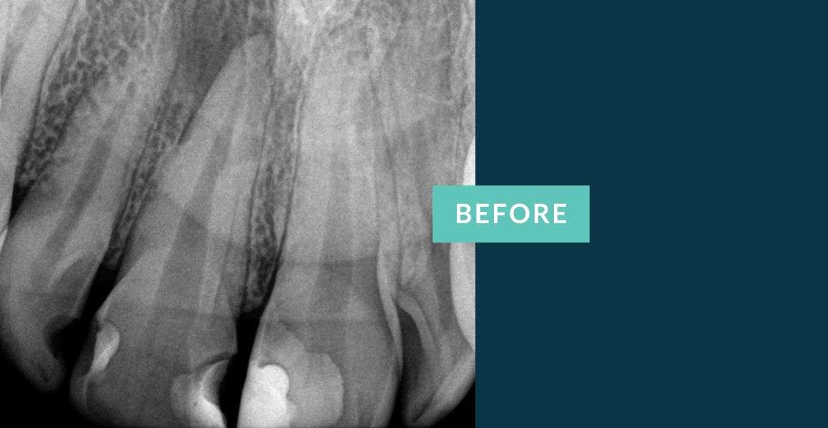 Before Anterior Tooth Root Canal Treatment