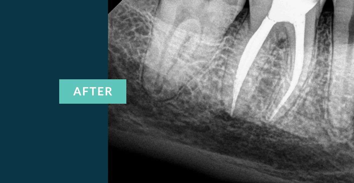 Before Molar Tooth Root Canal Treatment