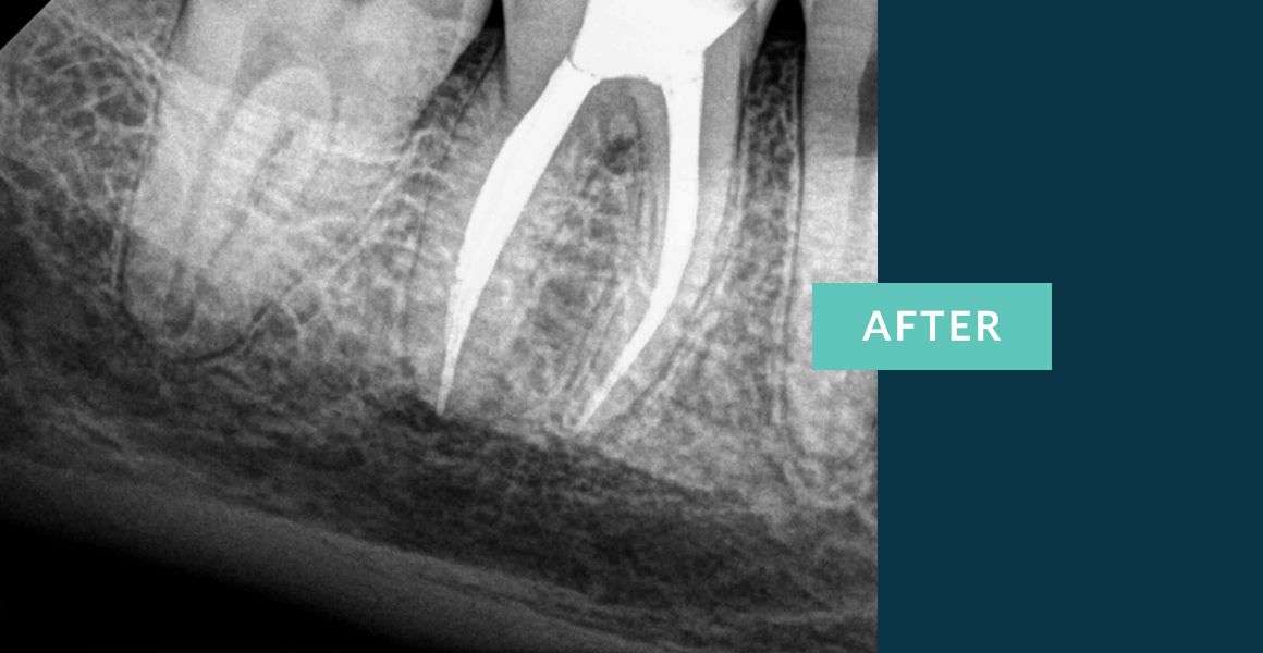 Molar Root Canal Treatment by Best NYC Root Canal Specialist- after