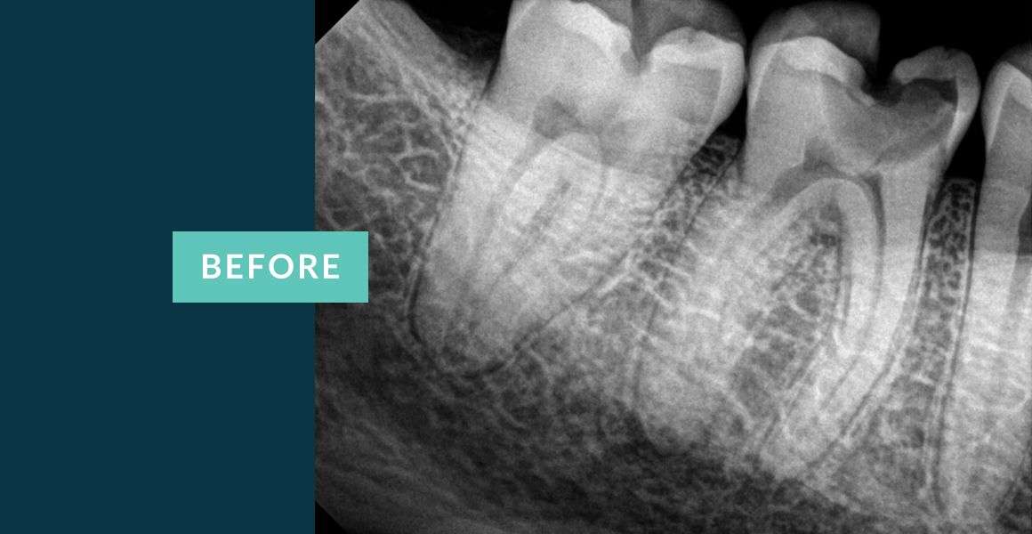 Before Molar Tooth Root Canal Treatment