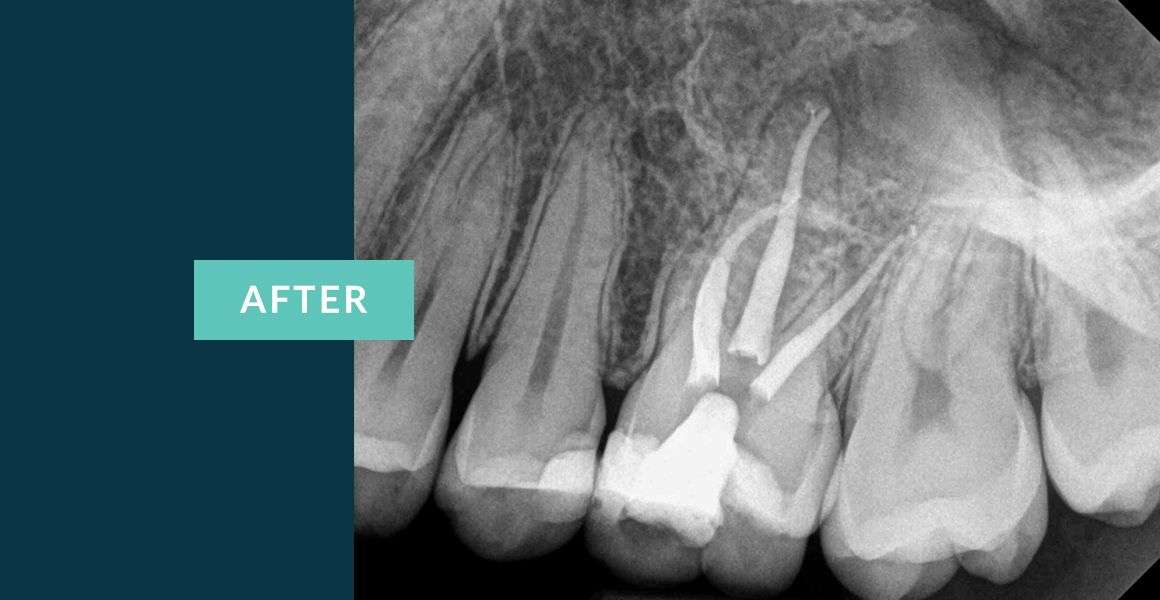 Before Molar Tooth Root Canal Treatment