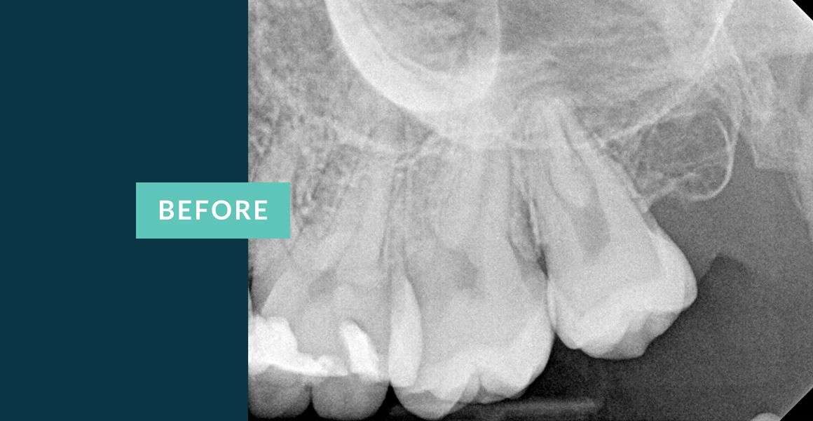 Before Molar Tooth Root Canal Treatment