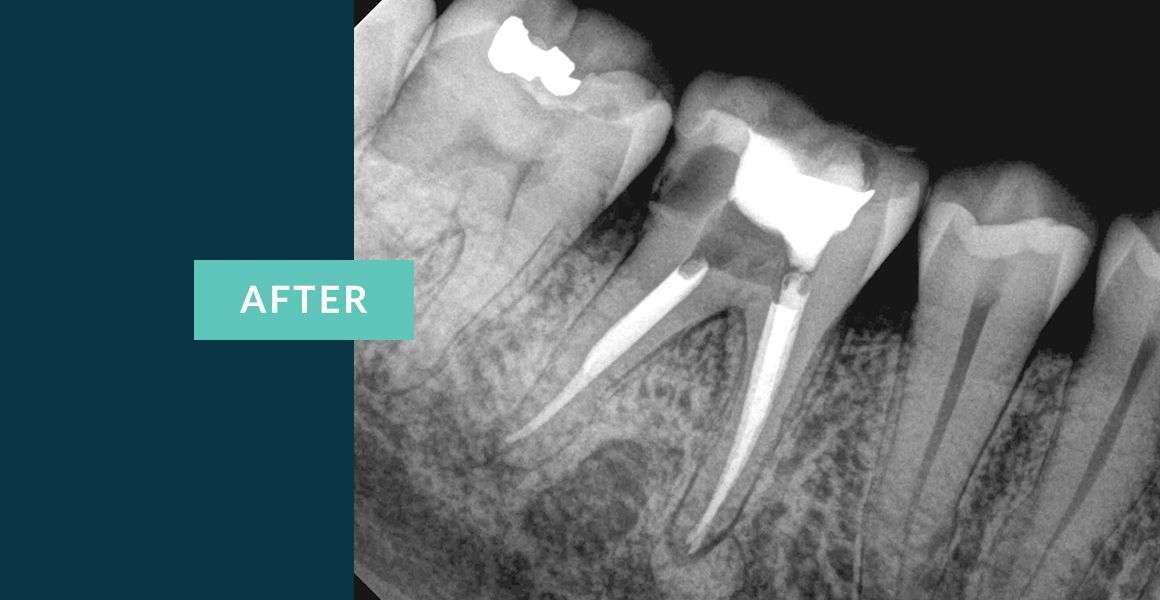 Before Molar Tooth Root Canal Treatment