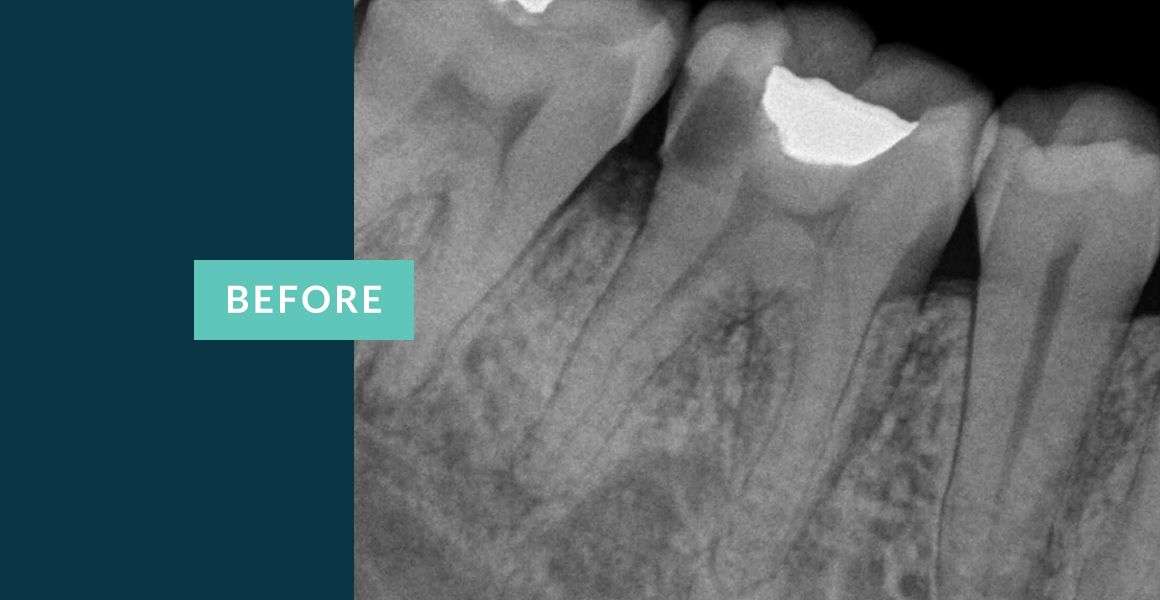 Before Molar Tooth Root Canal Treatment