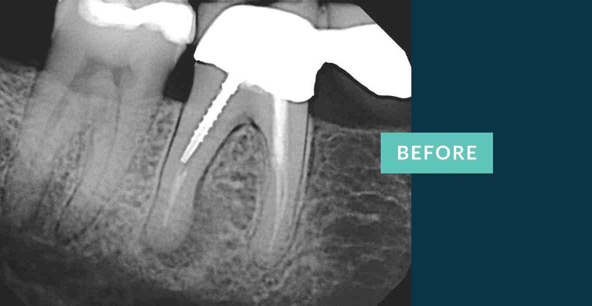 Before Retreatment of Root Canals