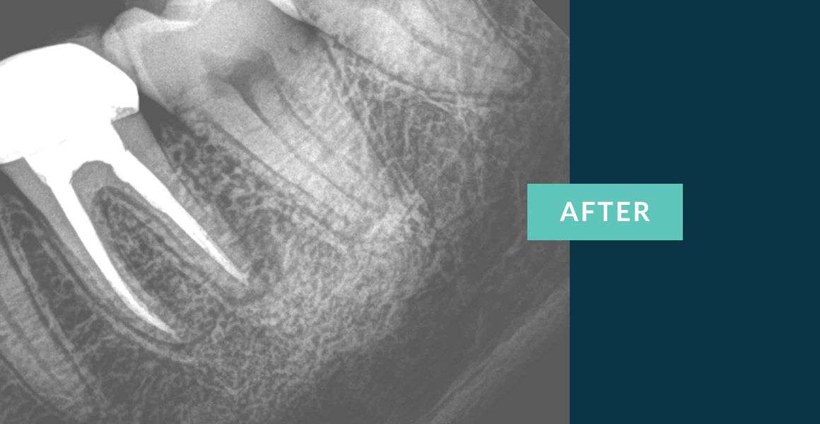 Before Retreatment of Root Canals