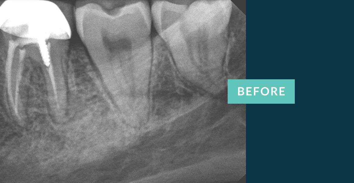 Before Retreatment of Root Canals