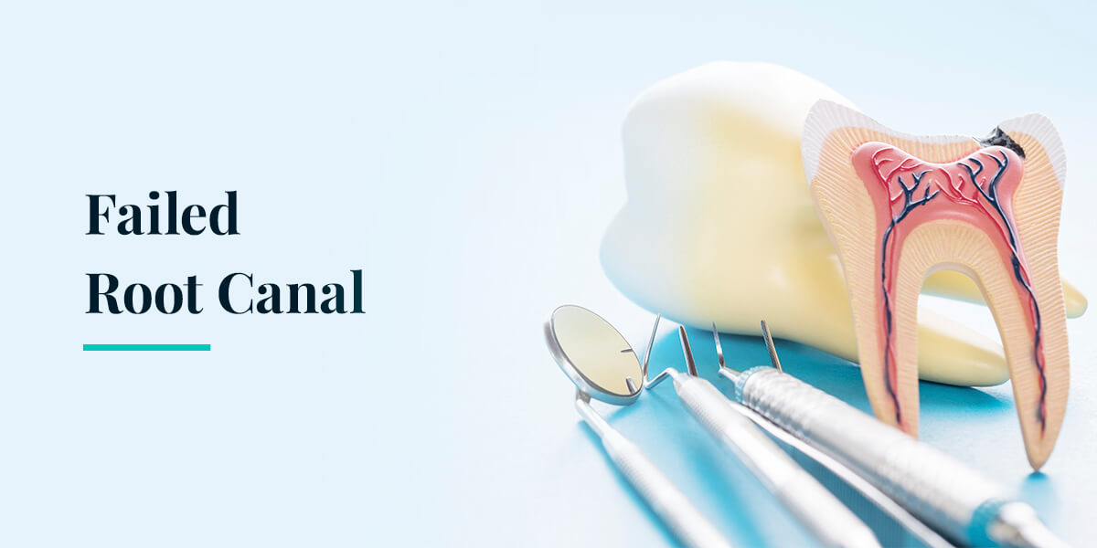 Failed Root Canal | Information, Symptoms & Treatment Options