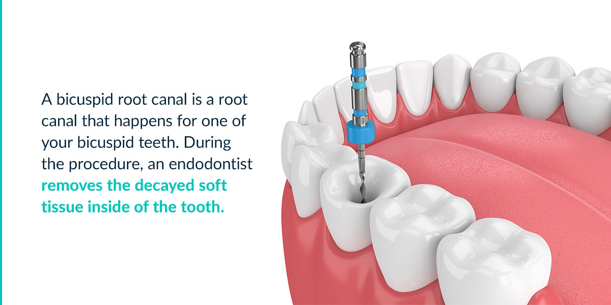 What Is a Bicuspid Root Canal?