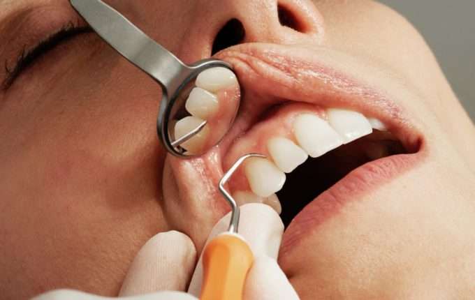 Root Canals and Health Problems