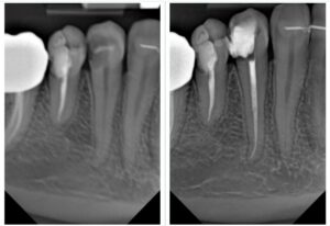 bicuspid root canal