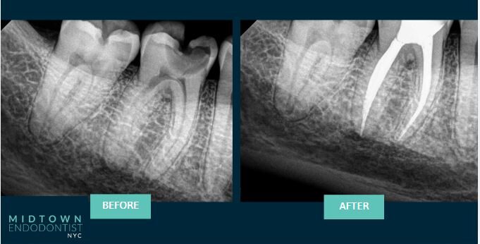 Root Canal Before Afters Midtown Endodontist Nyc Apicoectomy New York Root Canal Before Afters Midtown Endodontist Nyc Apicoectomy New York