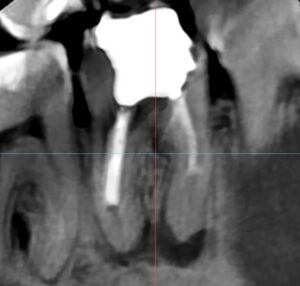 Periapical pathology lower molar CBCT