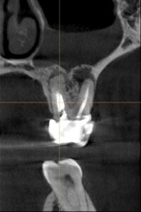 Periapical pathology upper molar CBCT