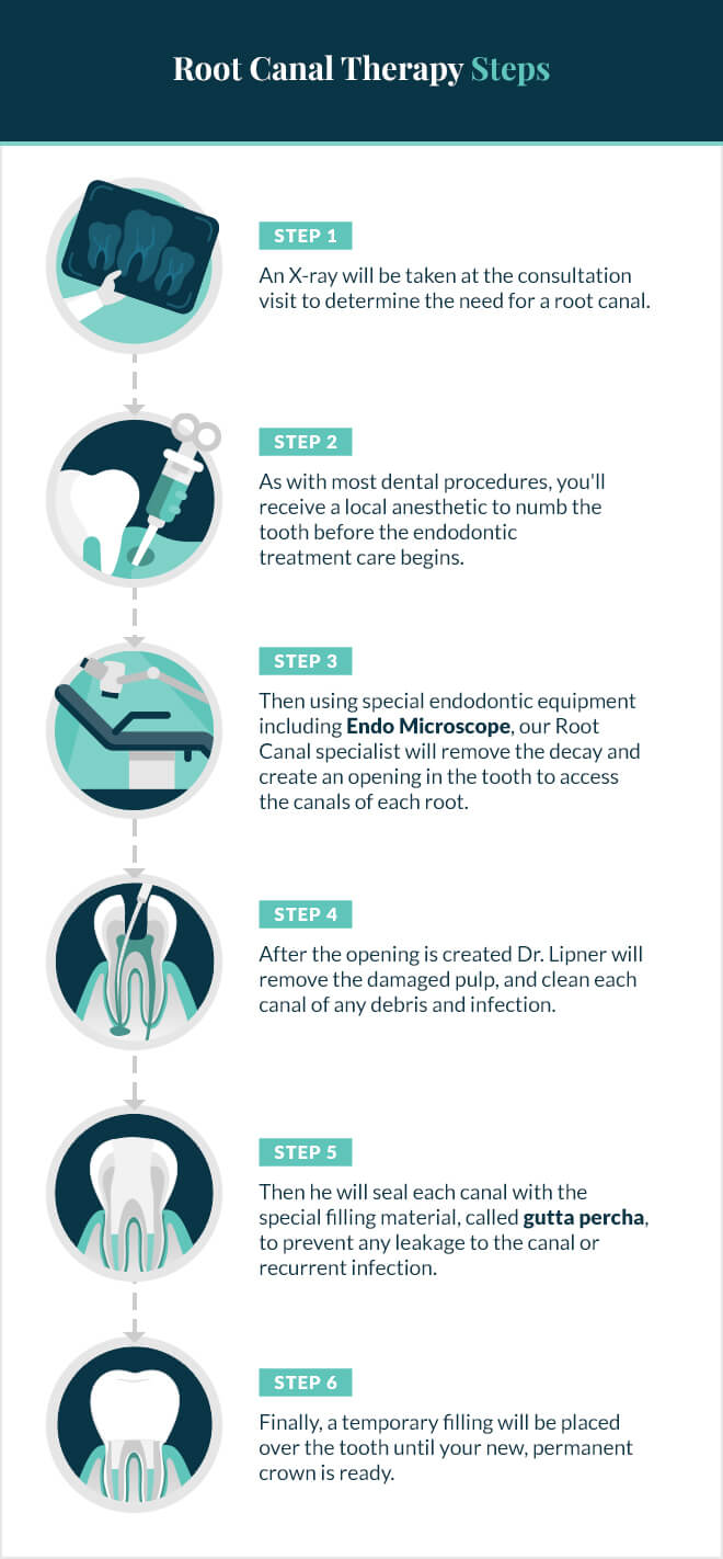Root canal process in Midtown Endodontist NYC