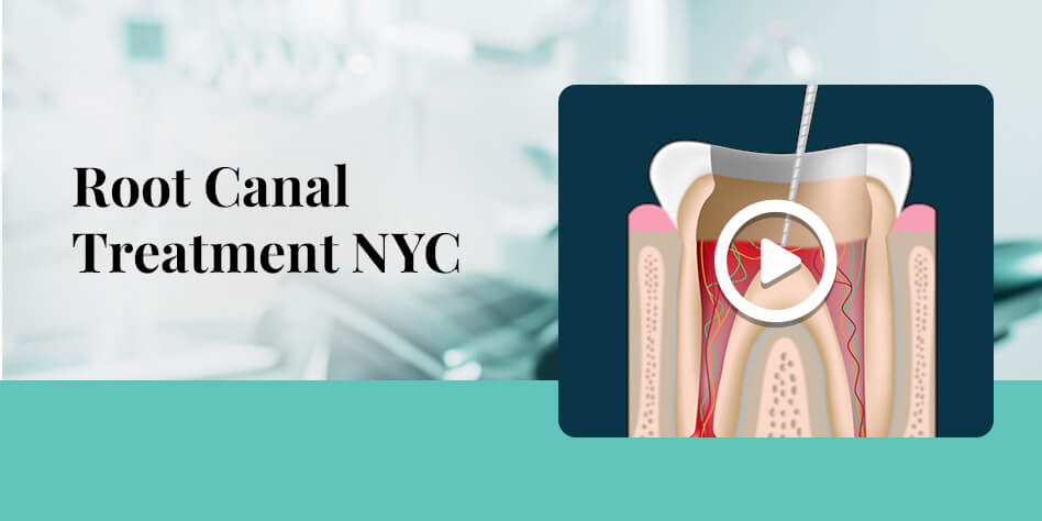 root canal treatment nyc