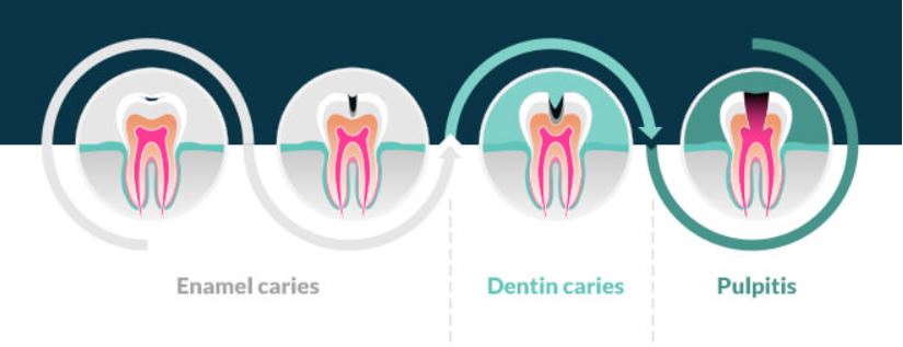 Diagram showing stages of tooth decay leading to pulpitis.