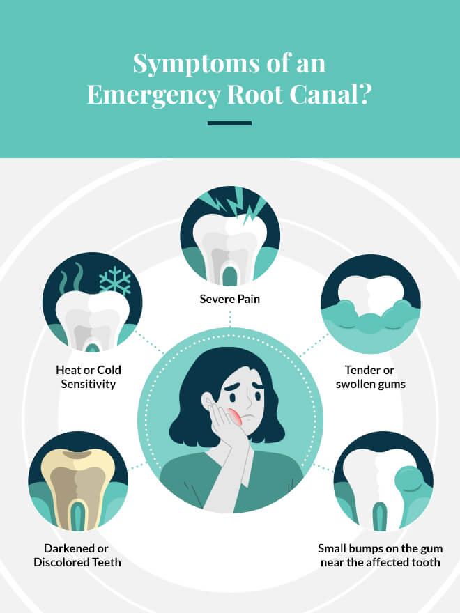 symptoms of an emergency root canal